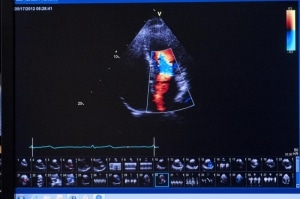 echocardiogram-plano-tx_800x531